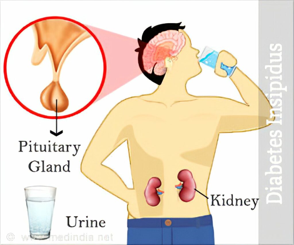 Diabetes Incipidus symptoms 