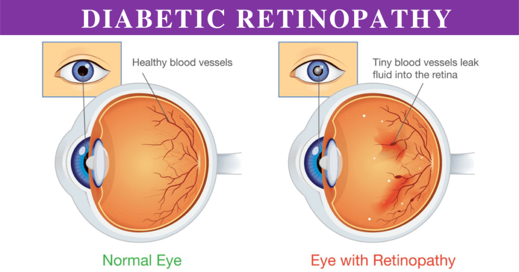 Diabetic retinopathy